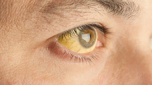 Yellow Fever